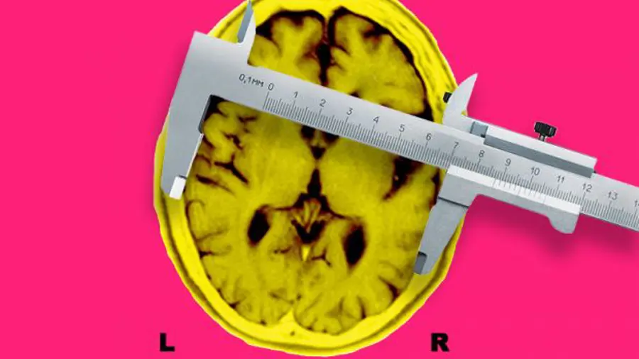 Mri Alzheimer Brain With Calipers