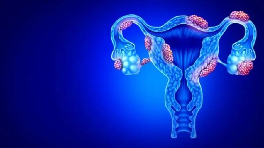 Graphic showing endometriosis